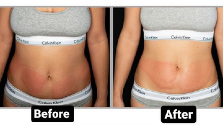 Best Cavitation Machine For You
