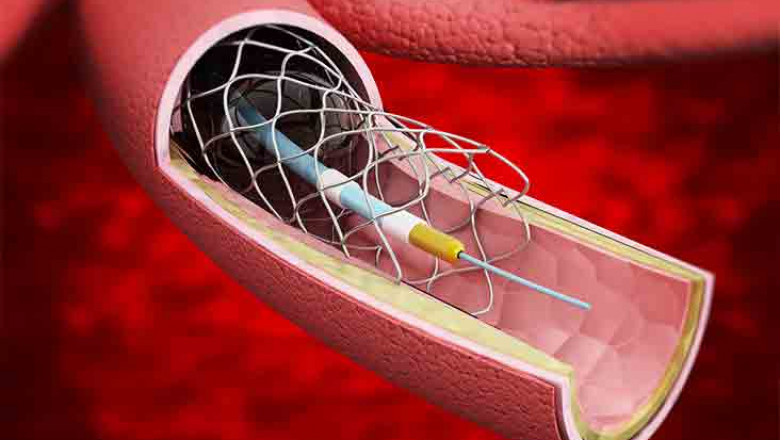 Cerebral Vascular Stent Market 2022: Size, Share, Analysis and Forecast-2027