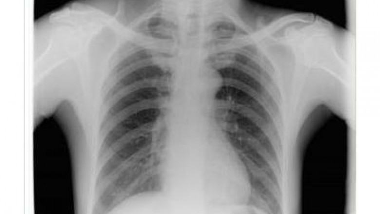 Medical X-ray Films Market - Industry Analysis, Market Size, Share, Trends, Application Analysis, Growth And Forecast 2021 - 2026