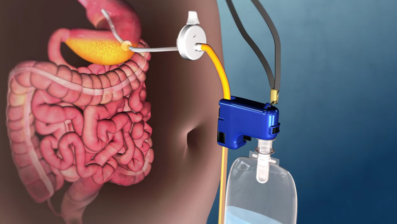 Is it possible to use Tums after a Bariatric Surgery Devices?