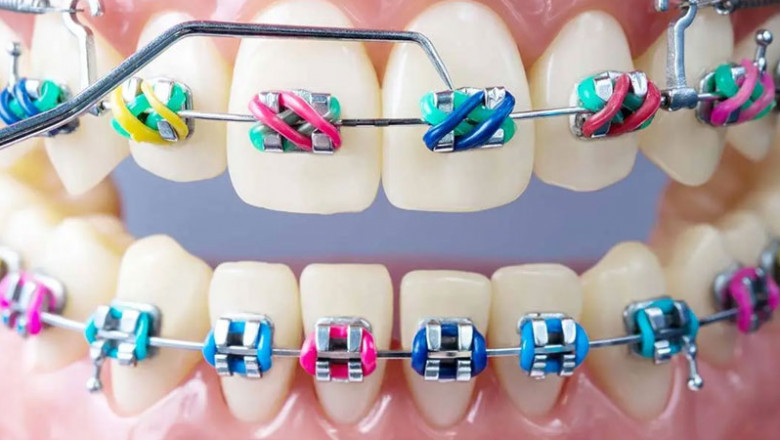 Are Metal Braces Good For Your Teeth?