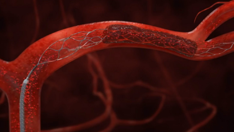 Mechanical Thrombectomy Devices Market Size Global Industry Demand, Share, Key Findings, Key Trends, Regional Analysis, Key Players Profiles, Future Prospects and Forecasts to 2027