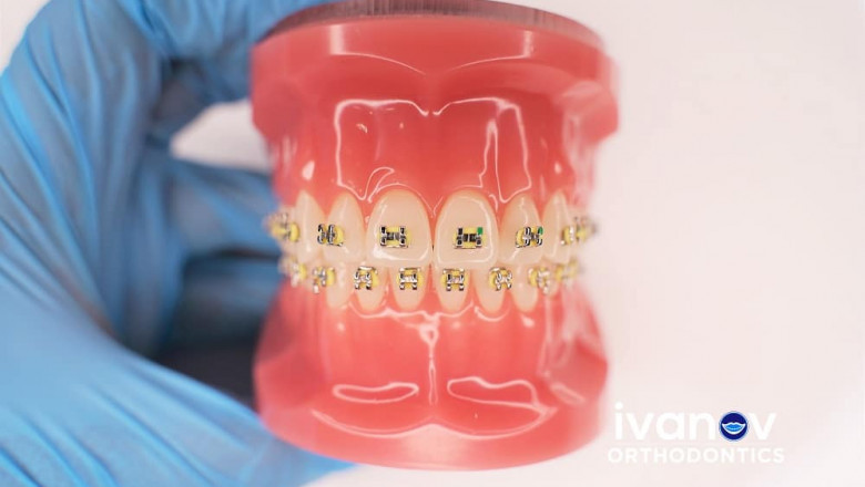 Is It Worth Getting A Permanent Retainer?