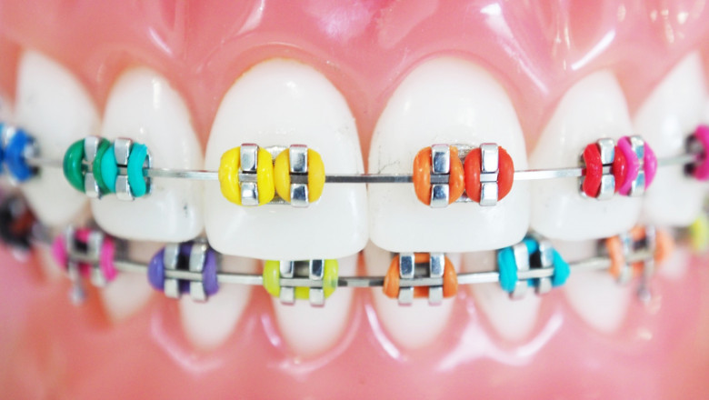 What Are The Braces Color For Boys That Change Their Looks?