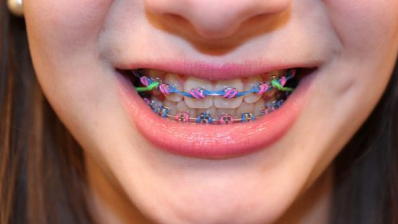 What Age Should My Child See An Orthodontist?