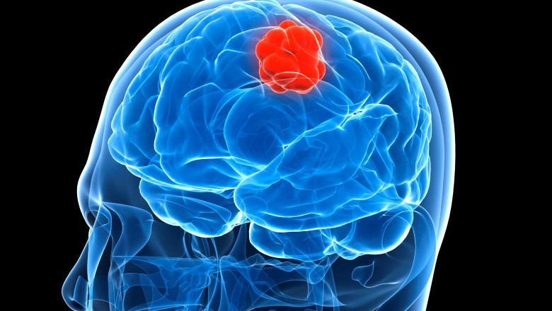 Worldwide Glioblastoma Multiforme Treatment Market By Product, Type, Mode, End User