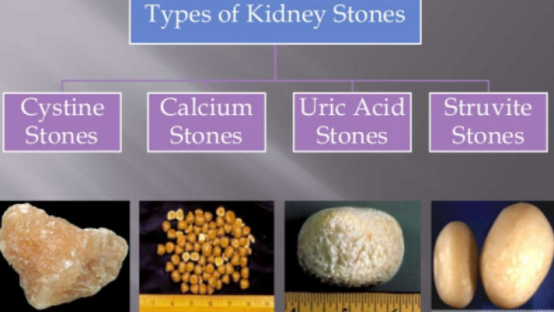 A Quick Guide On Kidney Stones And Their Types