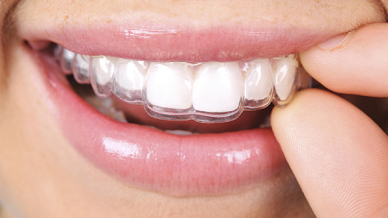 Why Should You Consider a Dentist Visit Every 6 Months?