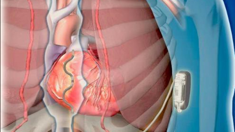 Cardiac Rhythm Management (CRM) Devices Market to Witness Pronounce Growth During 2019-2026