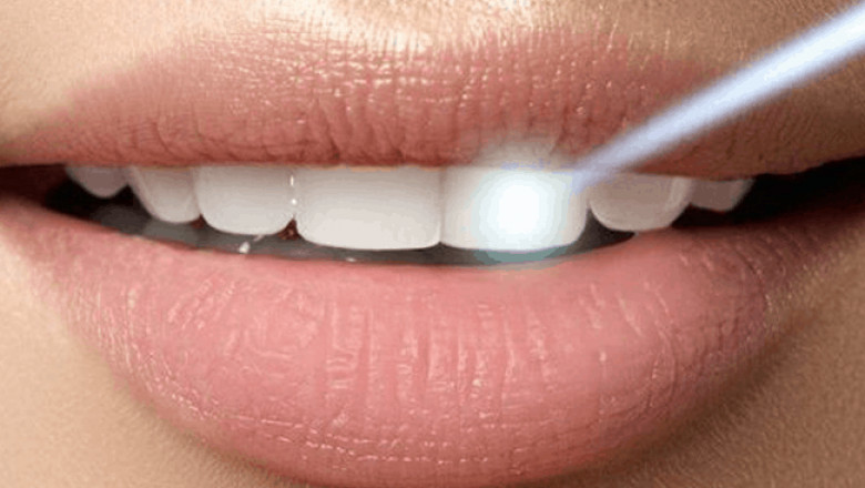How Long is the Recovery Time for Wisdom Teeth Extraction?