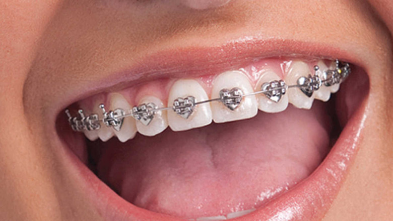 What Are The Benefits Of Metal Braces?