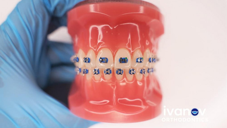 What Do You Understand About Permanent Retainers?