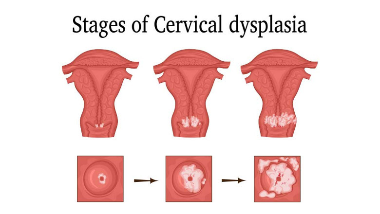 Cervical Dysplasia Market Challenges, Size, Growth, Key Vendors, Drivers, and Trends by Forecast to 2028