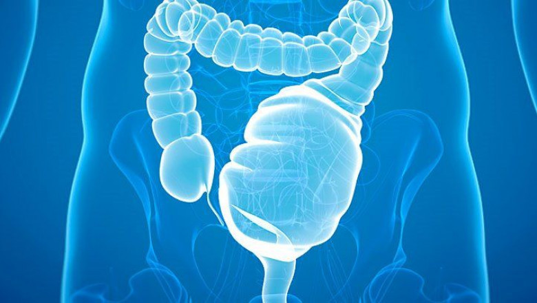Ulcerative Colitis only affects the lining of the large intestine (colon) and rectum