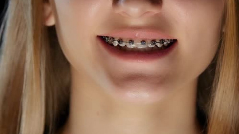 What Types Of Braces Are Best For Adults?