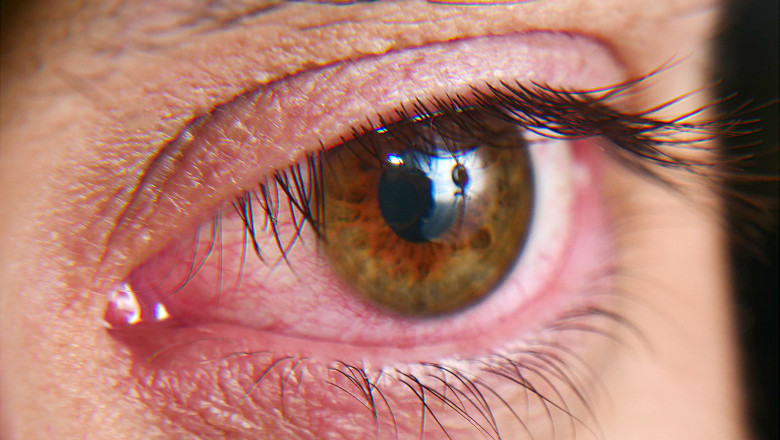 Dry Eye Syndrome Market Overview, Growth Analysis, Share, Opportunities and Global Forecast By 2026