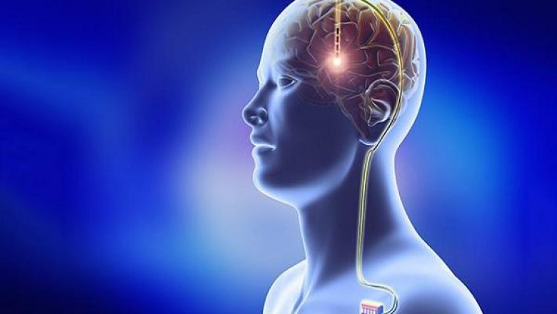 Deep Brain Stimulation Devices Market will generate new growth opportunities 2022-2028 | Boston Scientific Corporation, MEDTRONIC, Inc., St Jude Medical, Inc., Sapiens Neuro