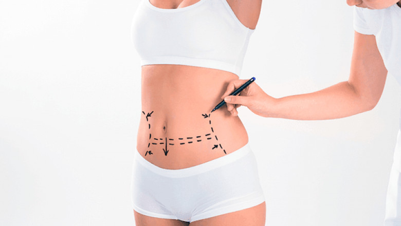 Tummy Tuck Complication Treatment