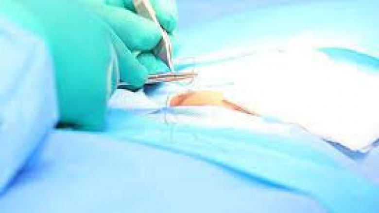 Best Hernia Surgery In Hyderabad