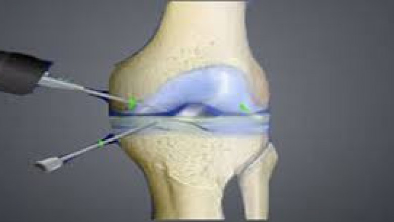 Best Knee Arthroscopy Surgery in Hyderabad