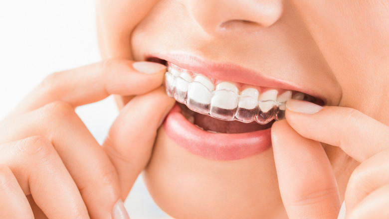 What Are The Things You Should Know Before Invisalign Treatment?