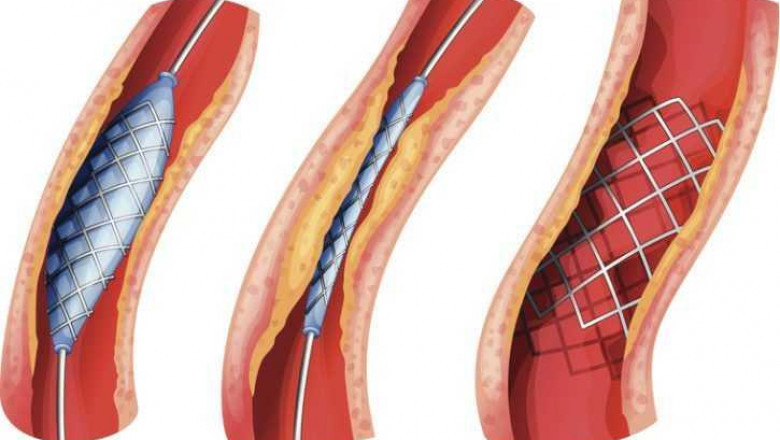 Atherectomy Devices Market 2021-2026: Industry Size, Share, Trends and Forecast