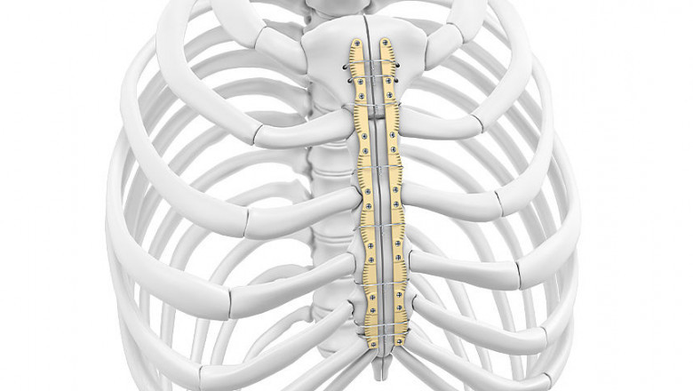 Global Sternal Closure Systems Market | Industry Size, Latest Trends, Key Segments, Region, Forthcoming Developments, and Forecast