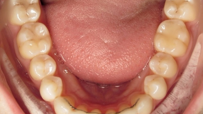 What More Do You Need To Know About Permanent Retainers?