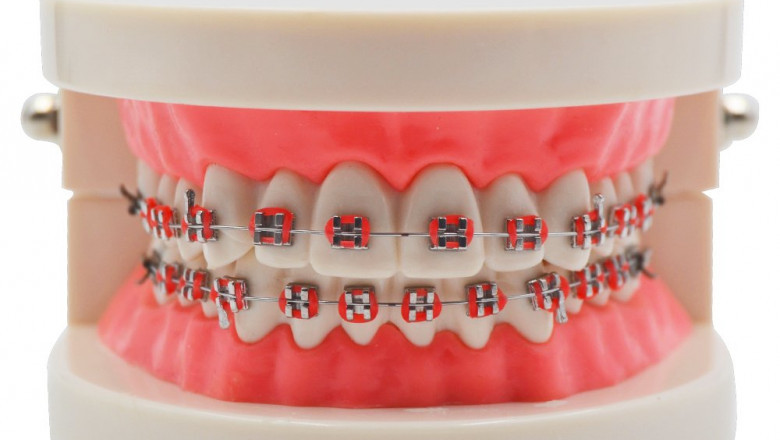 Which Is The Best Way To Get Braces Done?