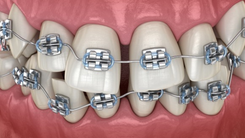How To Find Affordable Braces Miami? - bloggingpalace.com