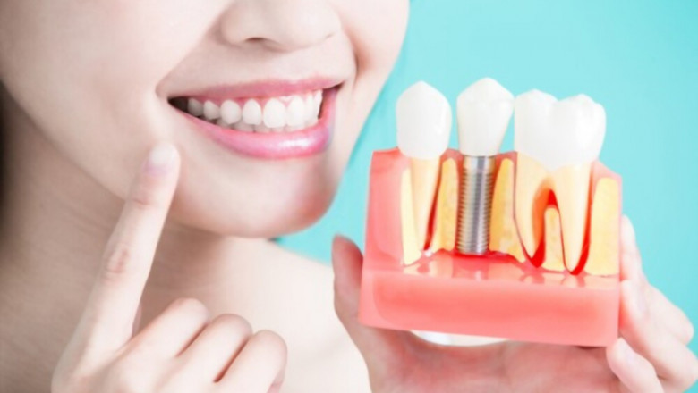 All about dental implants