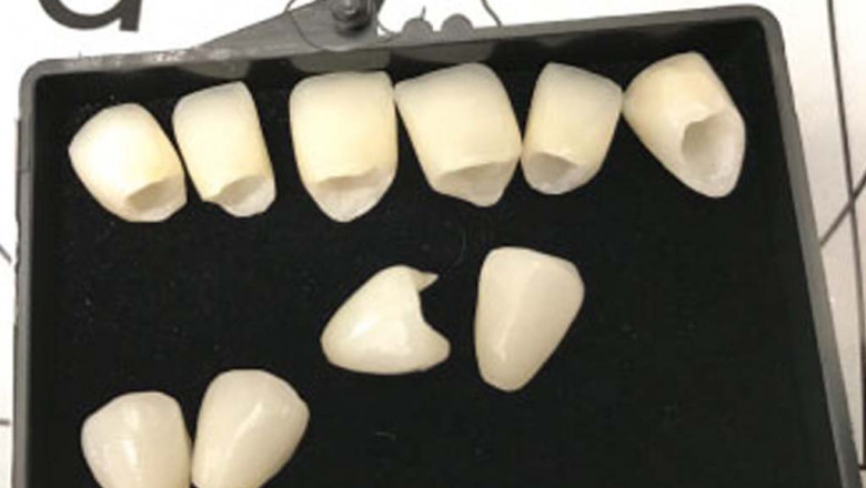 Why Do People Prefer Teeth Whitening Procedure?