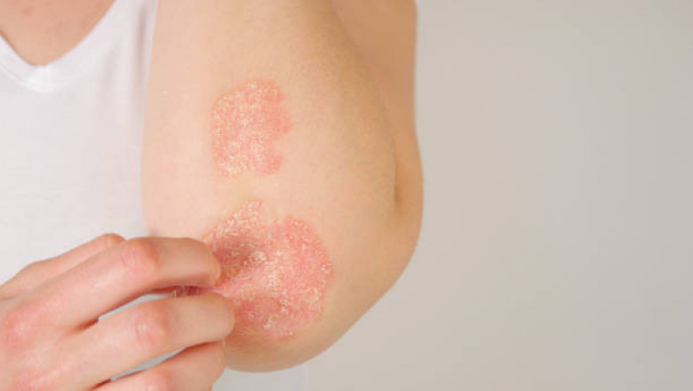 Psoriasis Treatment Market Key Business Strategies, Leading Industry Players, Regional Growth, Demand, Share, Challenges, Opportunities and 2027 Forecast Research Report