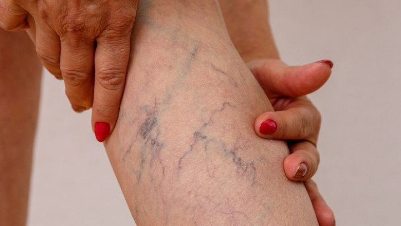 How To Select A Doctor To Treat Your Varicose?
