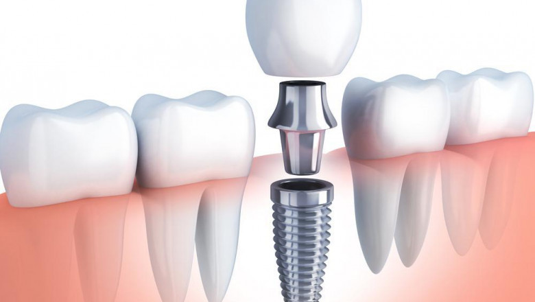 What Do You Understand About Dental Implants?