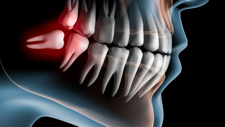 What Are Self-Care Suggestions For Wisdom Tooth Removal Recovery?