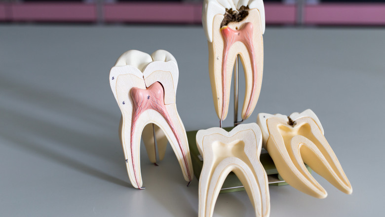What Exactly Is A Root Canal Procedure, And Why Is It Done?