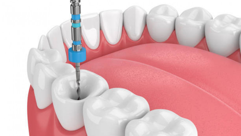 Endodontic Devices Market Growing with Highest Trends and Forecast Survey Till 2027