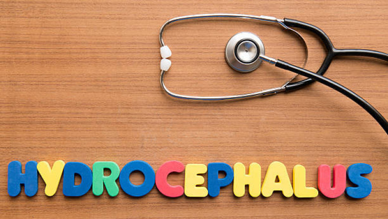 Hydrocephalus Market Report, Growth Insight, Deep Research & Segment Analysis 2027