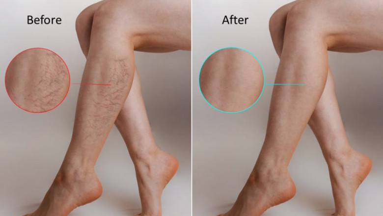 What Causes Varicose Veins?