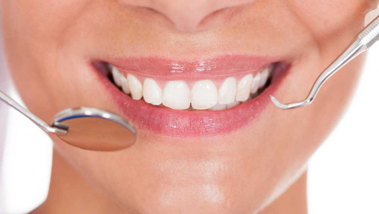 What Are The Types Of Dental Problems That Veneers Fix?