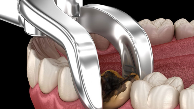 Why Do People Need A Wisdom Tooth Extraction?