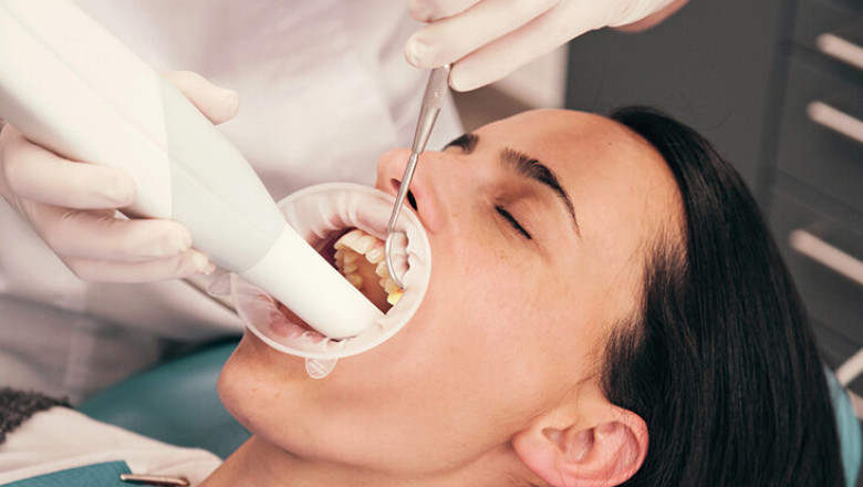 What Should We Know About Deep Dental Cleaning?