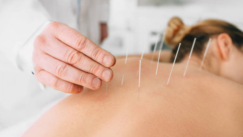 Acupuncture Market Size, Share 2022 | Latest Business Trends, Future Demands, Market Statistics, SWOT Analysis, Key Player’s Updates, Regional Segmentation Over the Forecast 2027