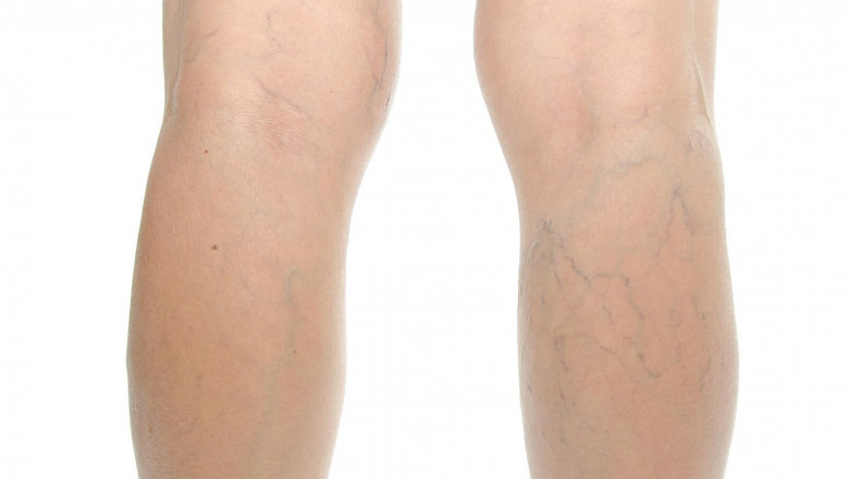What Are Varicose Veins?