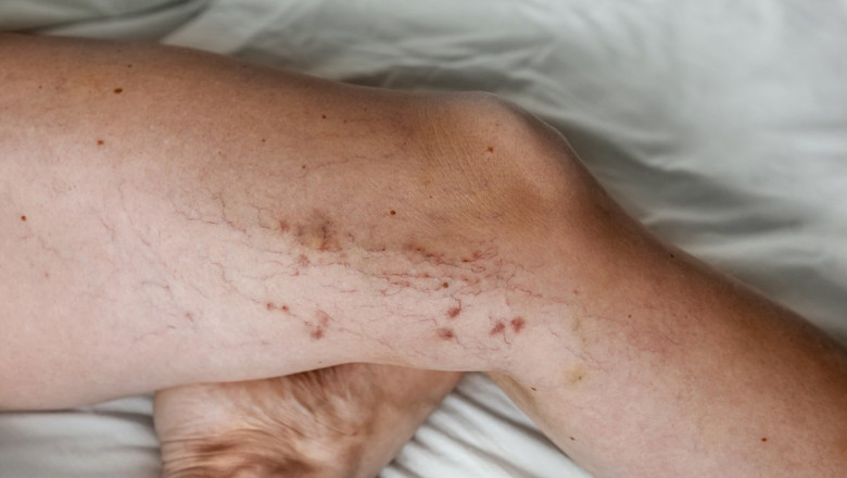 Why Do Varicose Veins Occur?