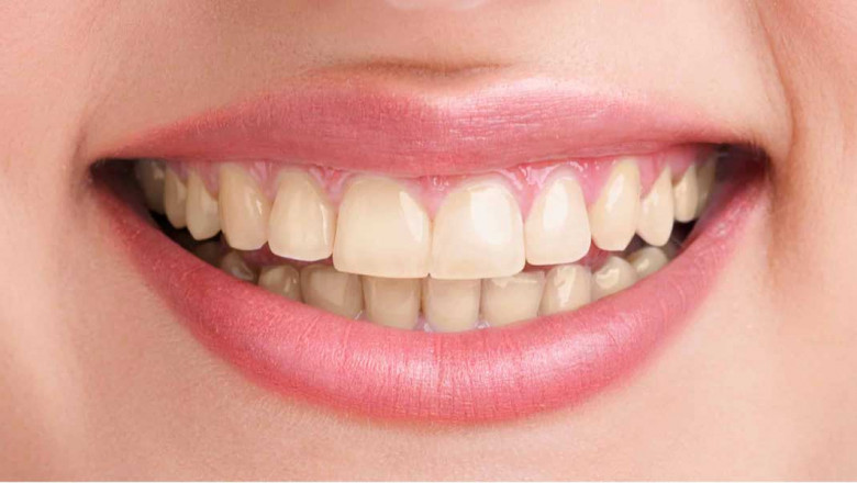 What Do You Know About Dental Bridges, And Who Needs Them?