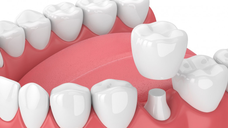 What Is The After-Care Instruction For Wisdom Tooth Removal?