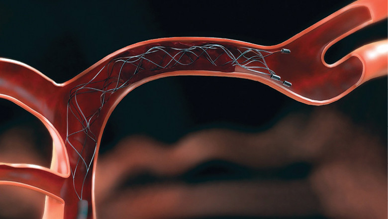 Mechanical Thrombectomy Devices Market Key Opportunities and Forecast Up to 2028