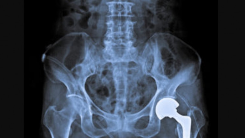 How Do I Know If My Knee Replacement Has Been Recalled?